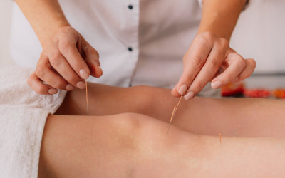 Tips for Choosing an Acupuncturist