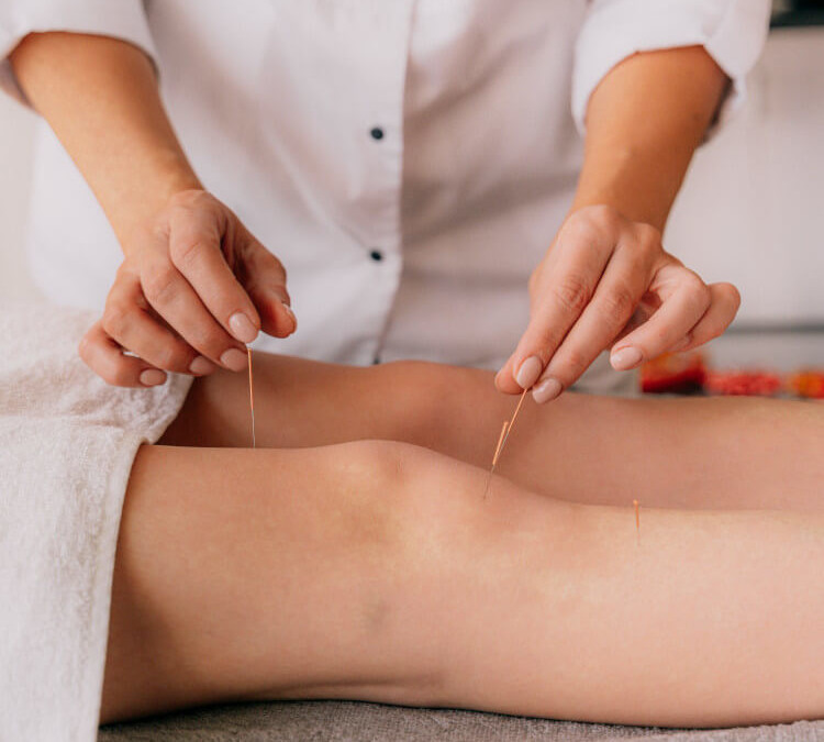 Tips for Choosing an Acupuncturist