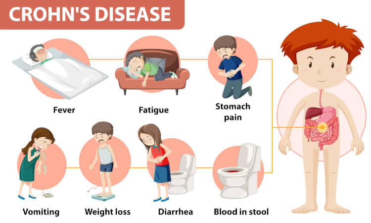 crohns disease infographic