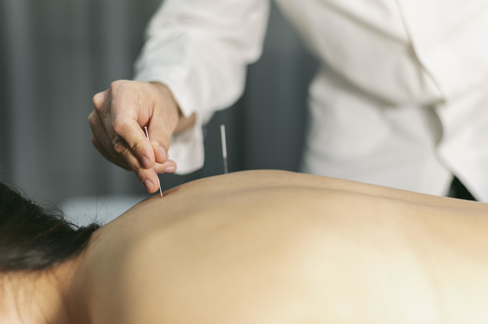 How Does Acupuncture Work for Nerve Pain?