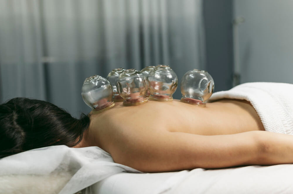 Acupuncture and Cupping as Effective Alternatives for Chronic Pain