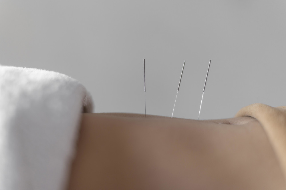 acupuncture in integrative oncology