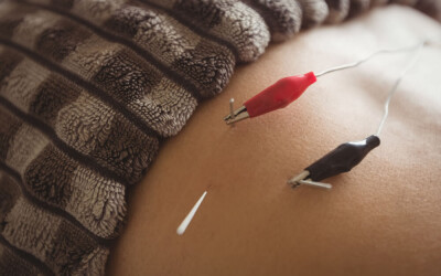 Electro-Acupuncture: How It Works, Components and Applications