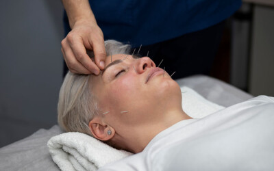 Facial Acupuncture: Unlocking Radiant Beauty and Holistic Well-Being