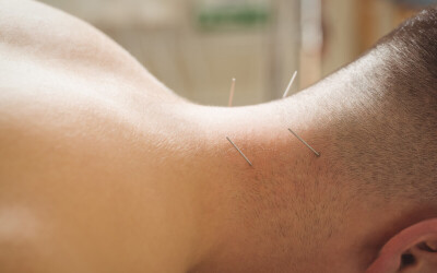Exploring the Efficacy of Acupuncture in Stroke Recovery: Mechanisms, Evidence, and Clinical Applications