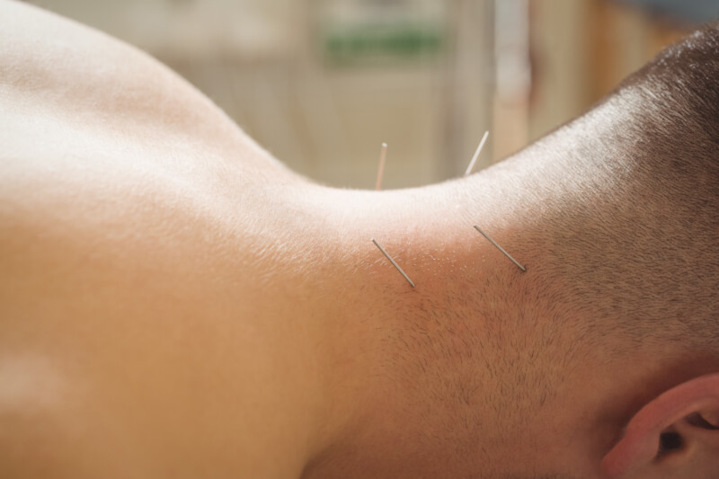 acupuncture for stroke recovery