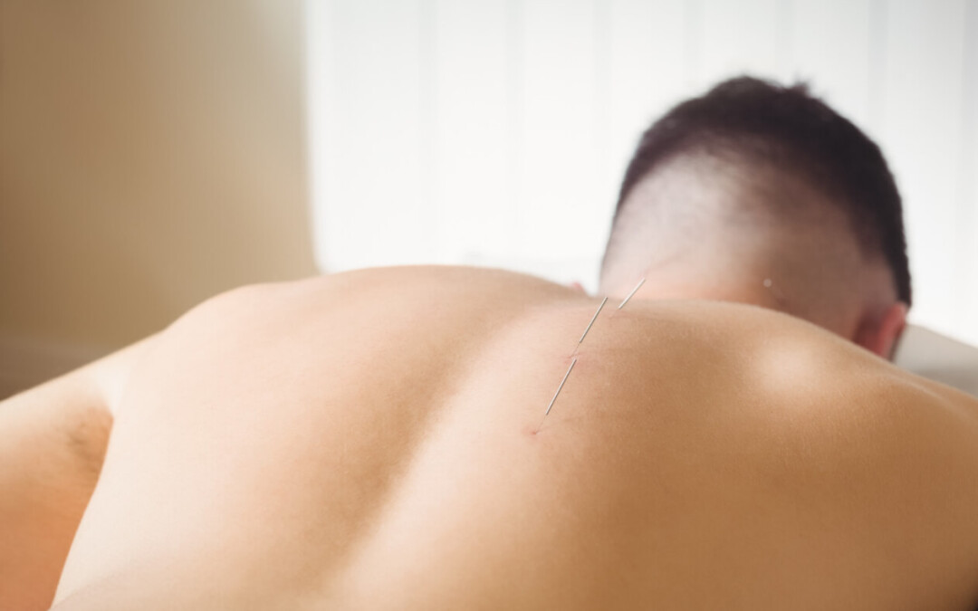 Acupuncture for Hormone Balance