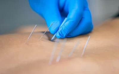 Using Acupuncture to Cleanse After Antibiotics or Medication Use