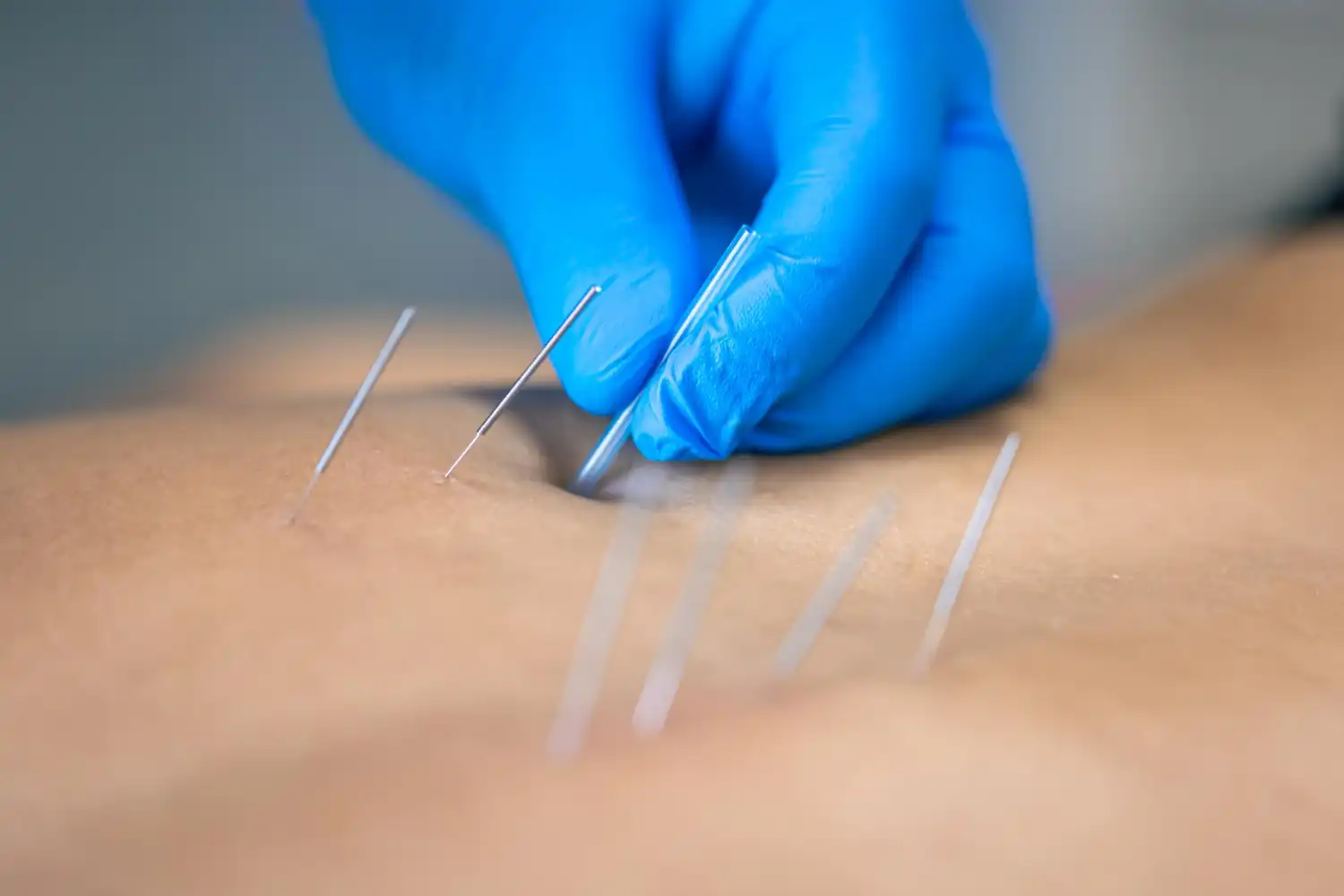 acupuncture to cleanse after antibiotics