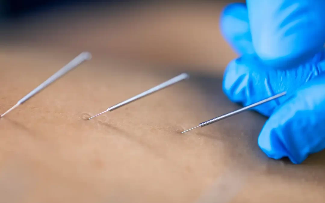 Detoxing Heavy Metals and Toxins with Acupuncture