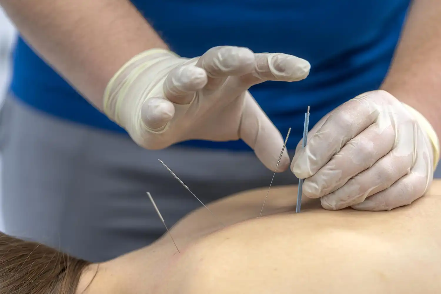 acupuncture for chronic cough