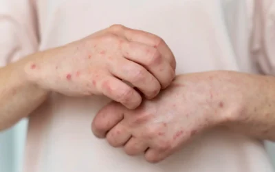 Eczema vs. Psoriasis in Oriental Medicine: Different Rashes, Different Root Causes