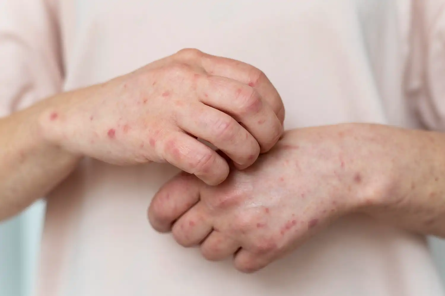 acupuncture for eczema and psoriasis