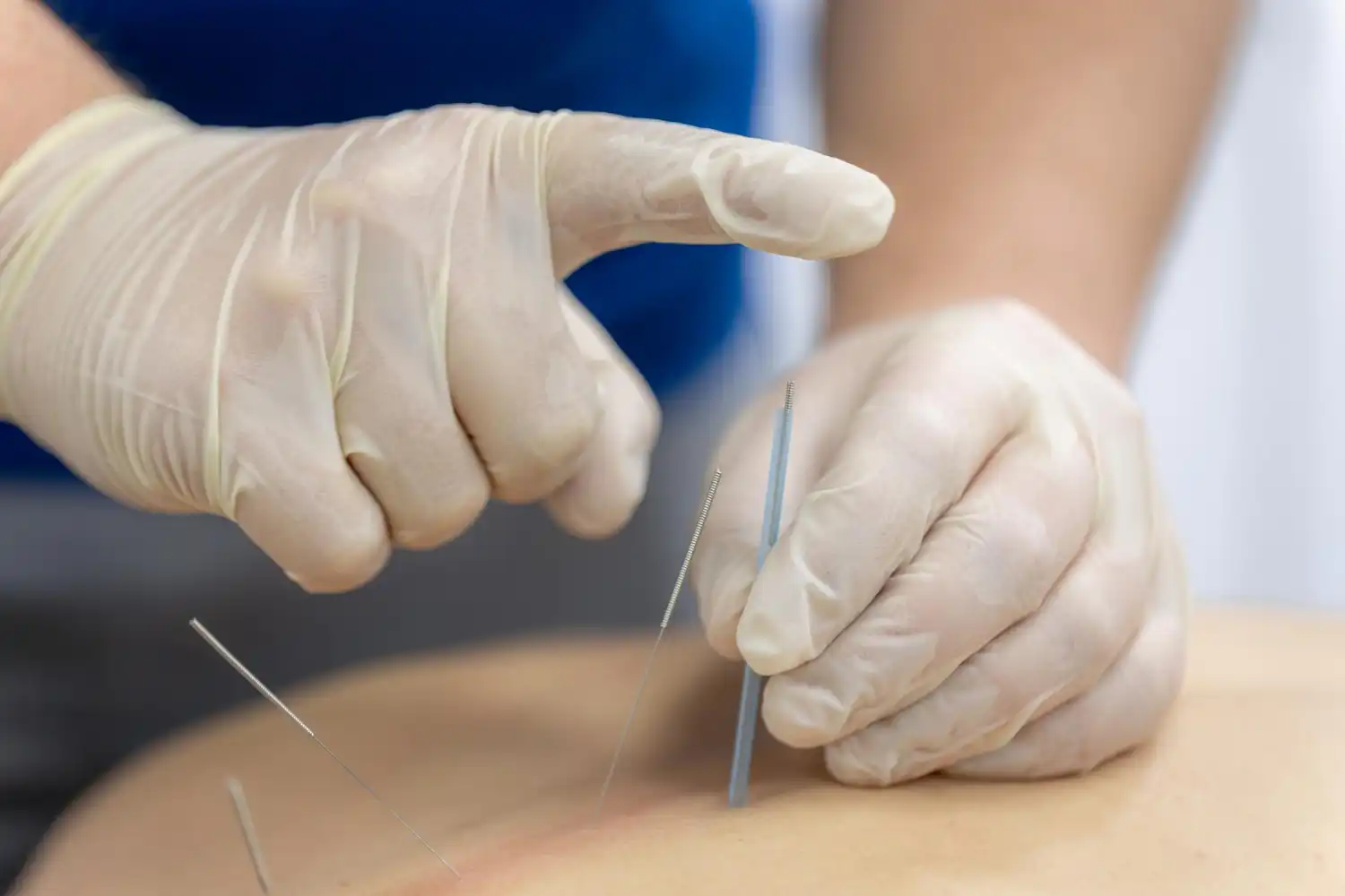 acupuncture point stimulation